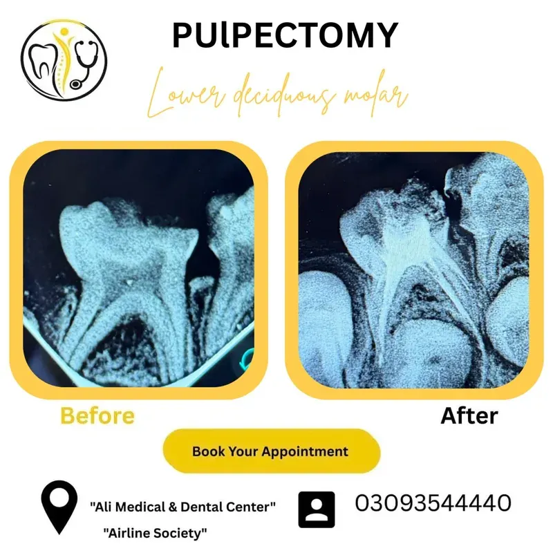 Before and after X-rays of a pulpectomy on a lower baby molar