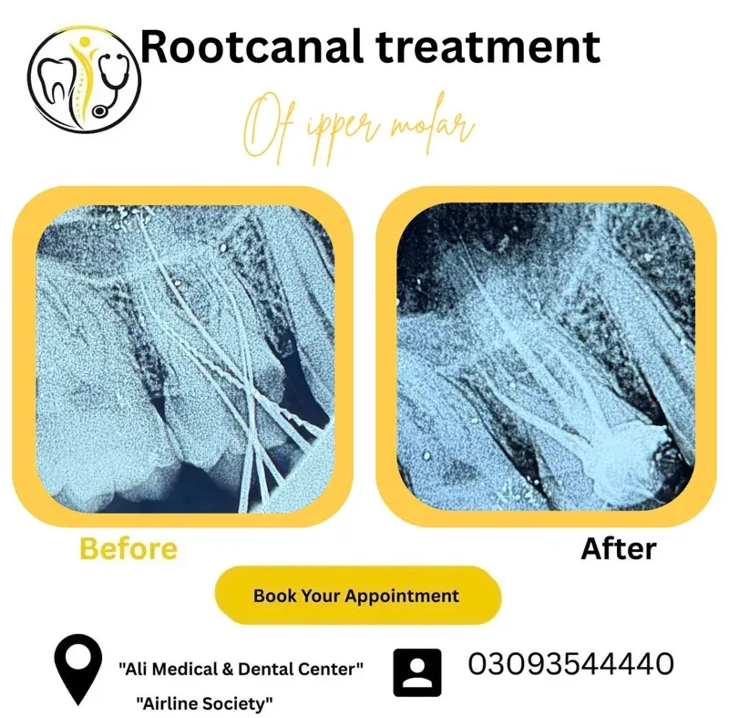Before and after X-rays of root canal treatment on an upper molar