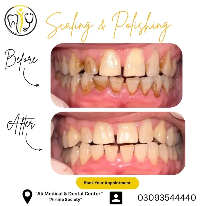 Teeth before and after scaling and polishing, showing tartar removed