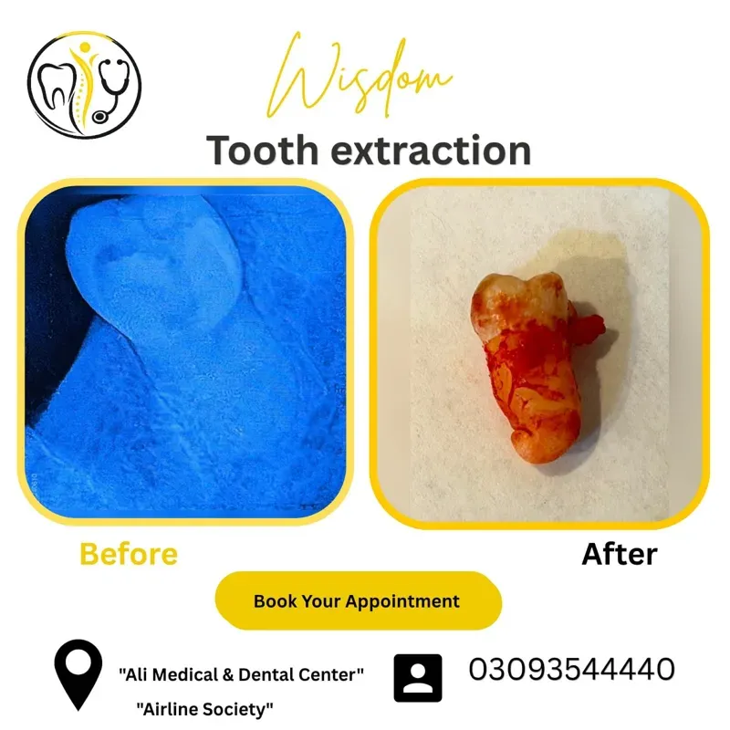 Wisdom tooth extraction: X-ray before and the extracted tooth after